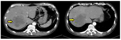 CASE LÂM SÀNG: ĐIỀU TRỊ UNG THƯ ĐẠI TRÀNG GIAI ĐOẠN MUỘN BẰNG HÓA CHẤT KẾT HỢP THUỐC KHÁNG TĂNG SINH MẠCH TẠI TRUNG TÂM YHHN VÀ UNG BƯỚU BỆNH VIỆN BẠCH MAI