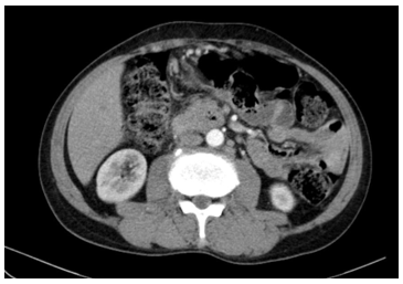 CA LÂM SÀNG HIỆU QUẢ ĐIỀU TRỊ HOÁ TRỊ CHO BỆNH NHÂN  UNG THƯ BIỂU MÔ TUYẾN KÉM BIỆT HOÁ DI CĂN HẠCH CHƯA RÕ NGUYÊN PHÁT