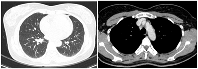 CASE LÂM SÀNG: CHẨN ĐOÁN BỆNH NHÂN MẮC HAI UNG THƯ:  GIST RUỘT NON VÀ UNG THƯ TUYẾN GIÁP TẠI TRUNG TÂM Y HỌC HẠT NHÂN VÀ UNG BƯỚU, BỆNH VIỆN BẠCH MAI