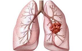 Trường hợp phát hiện u phổi khi đi khám bệnh tại Trung tâm Y học hạt nhân và Ung bướu Bệnh viện Bạch Mai