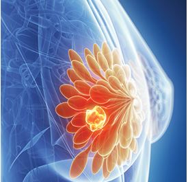 Ca lâm sàng: Bệnh nhân ung thư vú tái phát điều trị bằng liệu pháp nội tiết kết hợp thuốc ức chế CDK 4/6