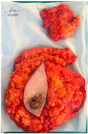 CA LÂM SÀNG: ĐIỀU TRỊ TÂN BỔ TRỢ VỚI PHÁC ĐỒ TCH Ở BỆNH NHÂN UNG THƯ VÚ TẠI BỆNH VIỆN BẠCH MAI