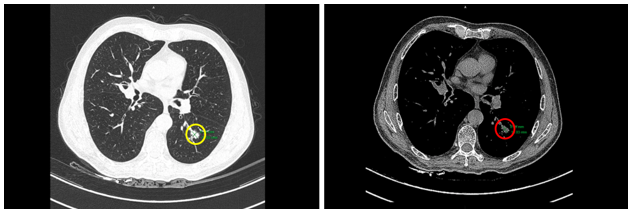 CASE LÂM SÀNG:  VAI TRÒ CỦA PET/CT TRONG ĐÁNH GIÁ GIAI ĐOẠN TRƯỚC ĐIỀU TRỊ Ở BỆNH NHÂN UNG THƯ PHỔI TẠI TRUNG TÂM YHHN VÀ UNG BƯỚU BỆNH VIỆN BẠCH MAI