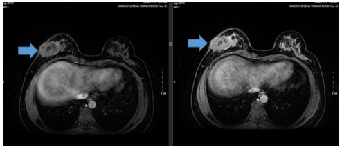Điều trị ung thư vú thể Her2 dương tính tại Trung tâm Y học hạt nhân và Ung bướu Bệnh viện Bạch Mai