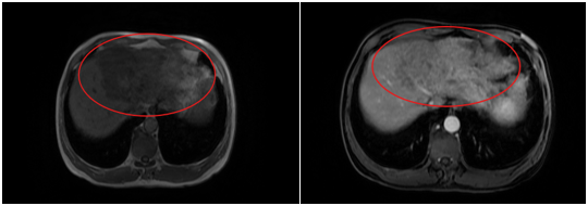Ca lâm sàng: Hiệu quả điều trị Atezolizumab kết hợp Bevacizumab trong điều trị ung thư biểu mô tế bào gan giai đoạn tiến xa.