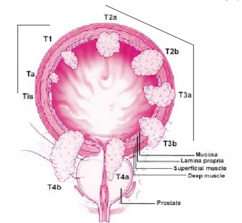 Рак мочевого пузыря у мужчин. Tis опухоли мочевого пузыря. Мочевой пузырь и яичники расположение. Опухоль мочевого пузыря похожая на цветную капусту.