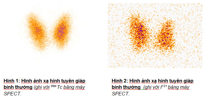 Vai trò của xạ hình SPECT trong ung thư tuyến giáp tại Trung tâm Y ...