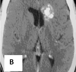 Vai trÃ² cá»§a CT, MRI, PET/CT trong cháº©n Ä'oÃ¡n vÃ  láº­p káº¿ hoáº¡ch xáº¡ pháº«u ung