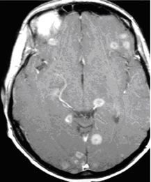 Vai trÃ² cá»§a CT, MRI, PET/CT trong cháº©n Ä'oÃ¡n vÃ  láº­p káº¿ hoáº¡ch xáº¡ pháº«u ung