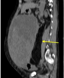 Case lâm sàng: Chẩn đoán sarcoma ổ bụng trên bệnh nhân tại Trung tâm Y học hạt nhân và ung bướu, Bệnh viện Bạch Mai