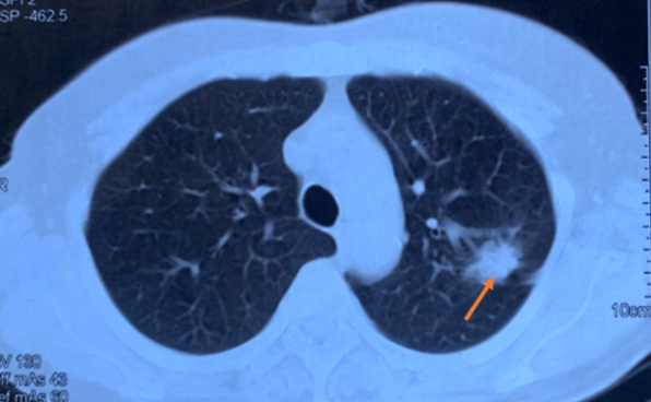 Bệnh nhân ung thư phổi giai đoạn muộn được điều trị ổn định bệnh 6 năm tại Trung tâm Y học hạt nhân và Ung bướu, Bệnh viện Bạch Mai