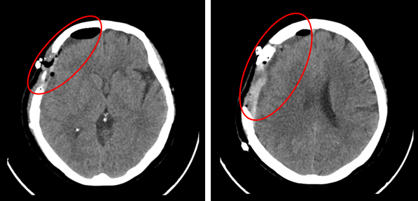 Ca lâm sàng:  Ung thư tuyến giáp thể nang di căn màng não  tại Trung tâm Y học hạt nhân và Ung bướu Bệnh viện Bạch Mai