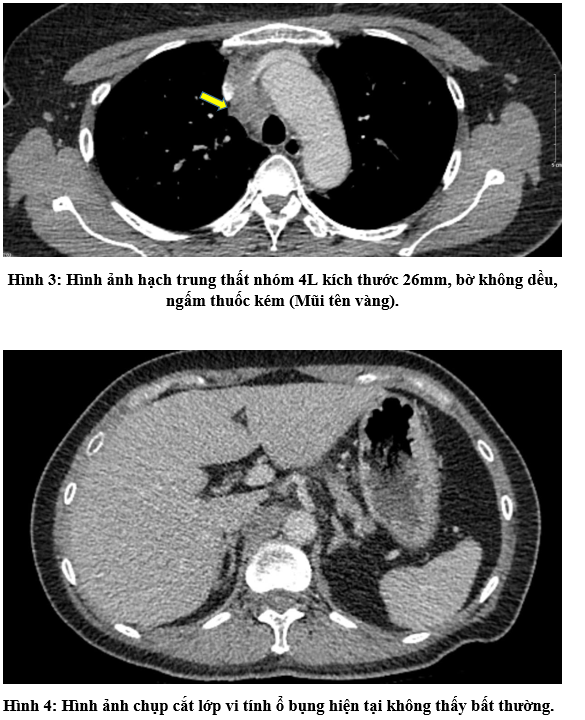 Ca lâm sàng: Kết hợp thuốc miễn dịch Pembrolizumab và hóa chất trong điều trị ung thư phổi giai đoạn tiến triển tại bệnh viện Bạch Mai