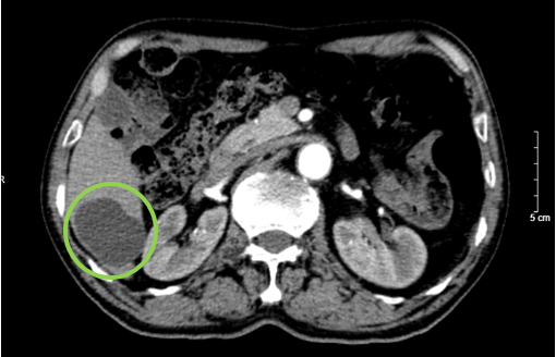 CASE LÂM SÀNG:  ĐIỀU TRỊ UNG THƯ PHỔI TẾ BÀO NHỎ BẰNG LIỆU PHÁP MIỄN DỊCH TẠI TRUNG TÂM YHHN VÀ UNG BƯỚU BỆNH VIỆN BẠCH MAI