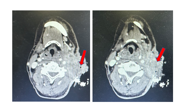 CASE LÂM SÀNG: VAI TRÒ CỦA PEMBROLIZUMAB TRONG ĐIỀU TRỊ UNG THƯ ĐẦU CỔ GIAI ĐOẠN TÁI PHÁT/DI CĂN