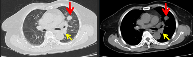 CASE LÂM SÀNG:   ĐIỀU TRỊ MIỄN DỊCH BỆNH NHÂN UNG THƯ HẮC TỐ DI CĂN HẠCH, PHỔI TẠI TRUNG TÂM Y HỌC HẠT NHÂN VÀ UNG BƯỚU, BỆNH VIỆN BẠCH MAI.