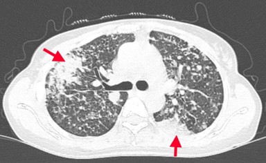 CA LÂM SÀNG ĐIỀU TRỊ ĐÍCH BỆNH NHÂN UNG THƯ PHỔI GIAI ĐOẠN MUỘN TẠI BỆNH VIỆN BẠCH MAI
