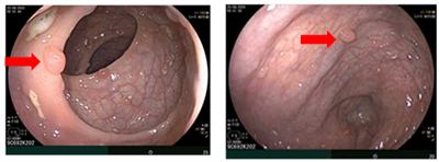 UNG THƯ DẠ DÀY KHỞI PHÁT SỚM