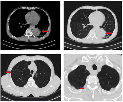 Ca lâm sàng: Điều trị bệnh nhân ung thư phổi không tế bào nhỏ giai đoạn di căn không có đột biến gen tại Trung tâm Y học hạt nhân và Ung bướu, Bệnh viện Bạch Mai