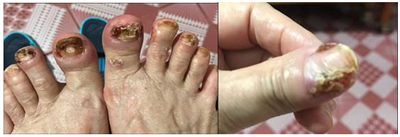 Tác dụng phụ của thuốc nhắm trúng đích (TKI) trong ung thư phổi không tế bào nhỏ và cách xử trí