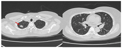 Ca lâm sàng:  Điều trị hóa chất kết hợp liệu pháp miễn dịch ở bệnh nhân ung thư phổi không tế bào nhỏ giai đoạn IV tại Trung tâm Y học hạt nhân và Ung bướu – Bệnh viện Bạch Mai