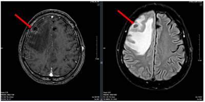 CASE LÂM SÀNG  ĐIỀU TRỊ MIỄN DỊCH  UNG THƯ PHỔI DI CĂN NÃO TẠI BỆNH VIỆN BẠCH MAI