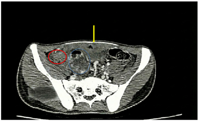 ĐIỀU TRỊ UNG THƯ ĐẠI TRÀNG BỊ VỠ U TRÊN BỆNH NHÂN VỊ THÀNH NIÊN 