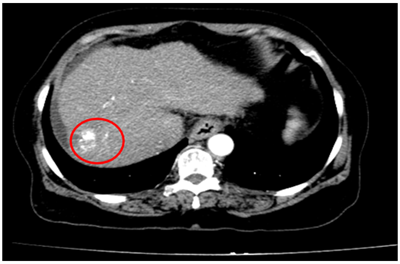 Ca lâm sàng: Điều trị ung thư biểu mô tế bào gan bằng thuốc điều trị đích Sorafenib tại Trung tâm Y học hạt nhân và Ung bướu, Bệnh viện Bạch Mai.