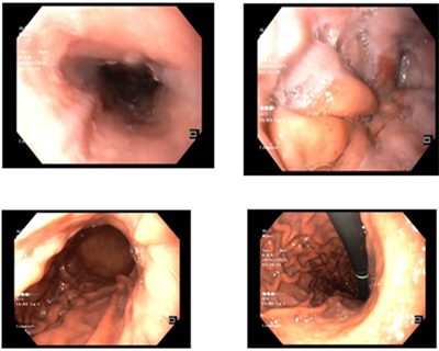 Điều trị Ung thư biểu mô tế bào gan giai đoạn tiến xa tại Trung tâm Y học hạt nhân và Ung bướu - Bệnh viện Bạch Mai