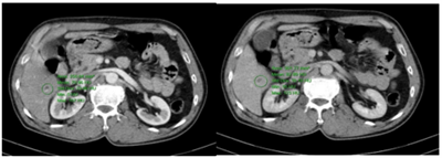 Ca lâm sàng: Chẩn đoán ung thư tuyến giáp di căn não tại Trung tâm Y học hạt nhân và Ung bướu, bệnh viện Bạch Mai