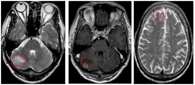 Ca lâm sàng: Điều trị đích bệnh nhân ung thư phổi không tế bào nhỏ giai đoạn muộn di căn nhiều cơ quan, tại Trung tâm Y học hạt nhân và Ung bướu – Bệnh viện Bạch Mai