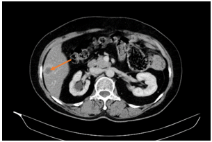CA LÂM SÀNG: ĐIỀU TRỊ UNG THƯ ĐẠI TRÀNG TÁI PHÁT DI CĂN PHỔI, TUYẾN THƯỢNG THẬN