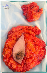 CA LÂM SÀNG: ĐIỀU TRỊ TÂN BỔ TRỢ VỚI PHÁC ĐỒ TCH Ở BỆNH NHÂN UNG THƯ VÚ TẠI BỆNH VIỆN BẠCH MAI