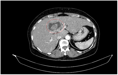 CA LÂM SÀNG  Chẩn đoán và điều trị bệnh nhân mắc đồng thời hai loại ung thư: Ung thư đại tràng và Ung thư đường mật
