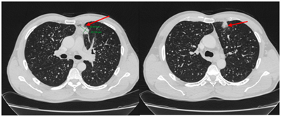 CASE LÂM SÀNG  “HIỆU QUẢ ĐIỀU TRỊ UNG THƯ PHỔI KHÔNG TẾ BÀO NHỎ GIAI ĐOẠN MUỘN BẰNG OSIMERTINIB TẠI BỆNH VIỆN BẠCH MAI’’