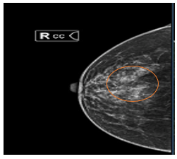 Ca lâm sàng:  Điều trị hóa chất tân bổ trợ ung thư vú giai đoạn sớm tại Trung tâm Y học hạt nhân và Ung bướu – Bệnh viện Bạch Mai