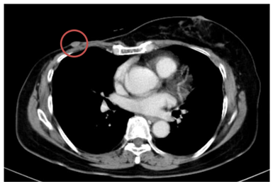 CASE LÂM SÀNG: ĐIỀU TRỊ ĐÍCH KẾT HỢP VỚI NỘI TIẾT CHO UNG THƯ VÚ TIẾN TRIỂN TẠI BỆNH VIỆN BẠCH MAI