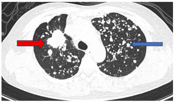 CA LÂM SÀNG  ĐIỀU TRỊ ĐÍCH BỆNH NHÂN UNG THƯ PHỔI GIAI ĐOẠN MUỘN TẠI BỆNH VIỆN BẠCH MAI