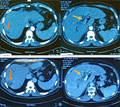 Ca lâm sàng: bệnh nhân ung thư phổi được điều trị đa mô thức tại Trung tâm Y học hạt nhân và Ung bướu bệnh viện Bạch Mai