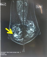 Tình cờ phát hiện ung thư vú khi đi khám sàng lọc miễn phí tại Trung tâm Y học hạt nhân và Ung bướu, Bệnh viện Bạch Mai