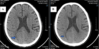 Case lâm sàng: Điều trị bệnh nhân ung thư phổi di căn não tại Trung tâm Y học hạt nhân và Ung bướu, Bệnh viện Bạch Mai.