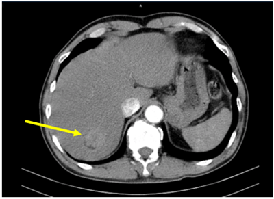 Ca lâm sàng: Bệnh nhân mắc 3 loại ung thư: ung thư hạ họng, ung thư biểu mô tế bào gan, ung thư thực quản tại Trung tâm Y học hạt nhân và Ung bướu Bệnh viện Bạch Mai