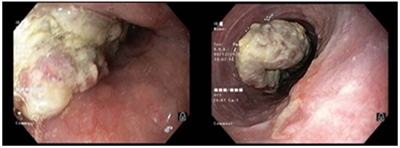 CASE LÂM SÀNG: U HẦU HỌNG - THỰC QUẢN