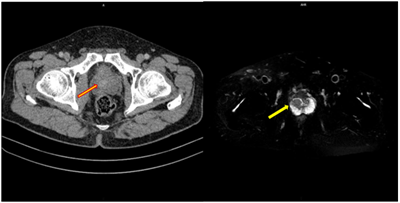 CASE LÂM SÀNG: Điều trị bệnh nhân mắc đồng thời hai loại ung thư: Ung thư phổi và ung thư tuyến tiền liệt
