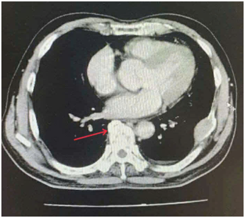 CA LÂM SÀNG: ĐIỀU TRỊ UNG THƯ PHỔI BIỂU MÔ TUYẾN DI CĂN XƯƠNG