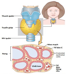 CẬP NHẬT VỀ CHỈ ĐỊNH ĐIỀU TRỊ I-131 TRONG UNG THƯ TUYẾN GIÁP THỂ BIỆT HÓA