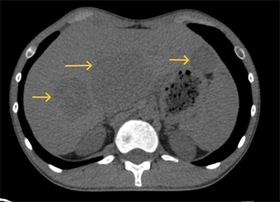 Case lâm sàng: Điều trị Sarcoma cơ vân vùng tiểu khung hiếm gặp ở người lớn tại Trung tâm Y học hạt nhân và Ung bướu, Bệnh viện Bạch Mai.