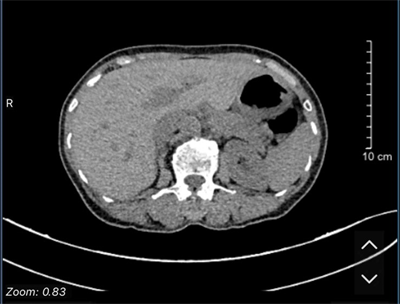 Case lâm sàng: Chẩn đoàn và điều trị ung thư tuyến giáp thể nhú di căn phổi tại Trung tâm Y học hạt nhân và Ung bướu, Bệnh viện Bạch Mai.