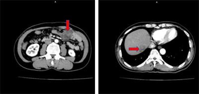 Ca lâm sàng: Ung thư biểu mô tế bào gan thể Sarcomatoid