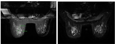 Điều trị Ung thư vú giai đoạn sớm đáp tốt với phác đồ hoá trị kết hợp với kháng thể đơn dòng kháng HER2  tại Trung tâm Y học hạt nhân và Ung bướu - Bệnh viện Bạch Mai
